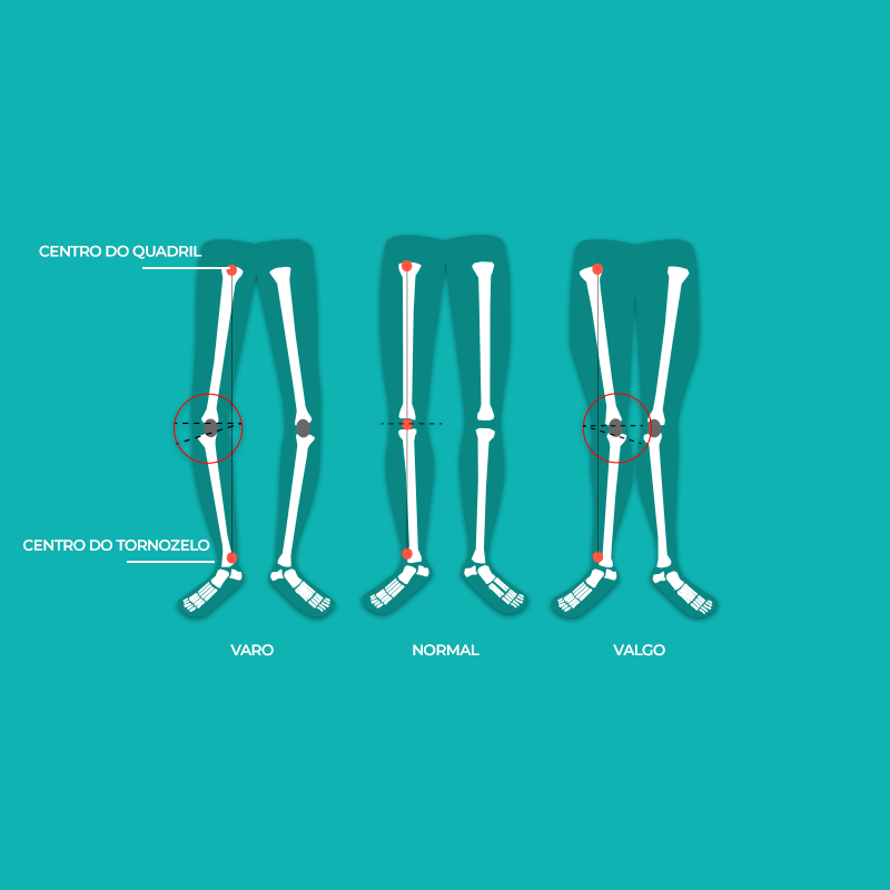 Muitas pessoas se perguntam quais são as causas de joelho torno. Confira a explicação do Hospital Ortopédico sobre o tema e saiba diferenciar joelho varo e joelho valgo