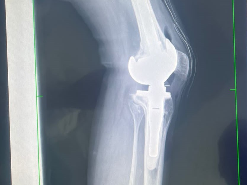 O Hospital Ortopédico AACD realizou uma cirurgia de joelho que é inédita na literatura médica mundial. Procedimento pode ser uma alternativa para pessoas com diagnóstico de Osteogênese Imperfeita, doença rara também conhecida como "Ossos de Vidro"