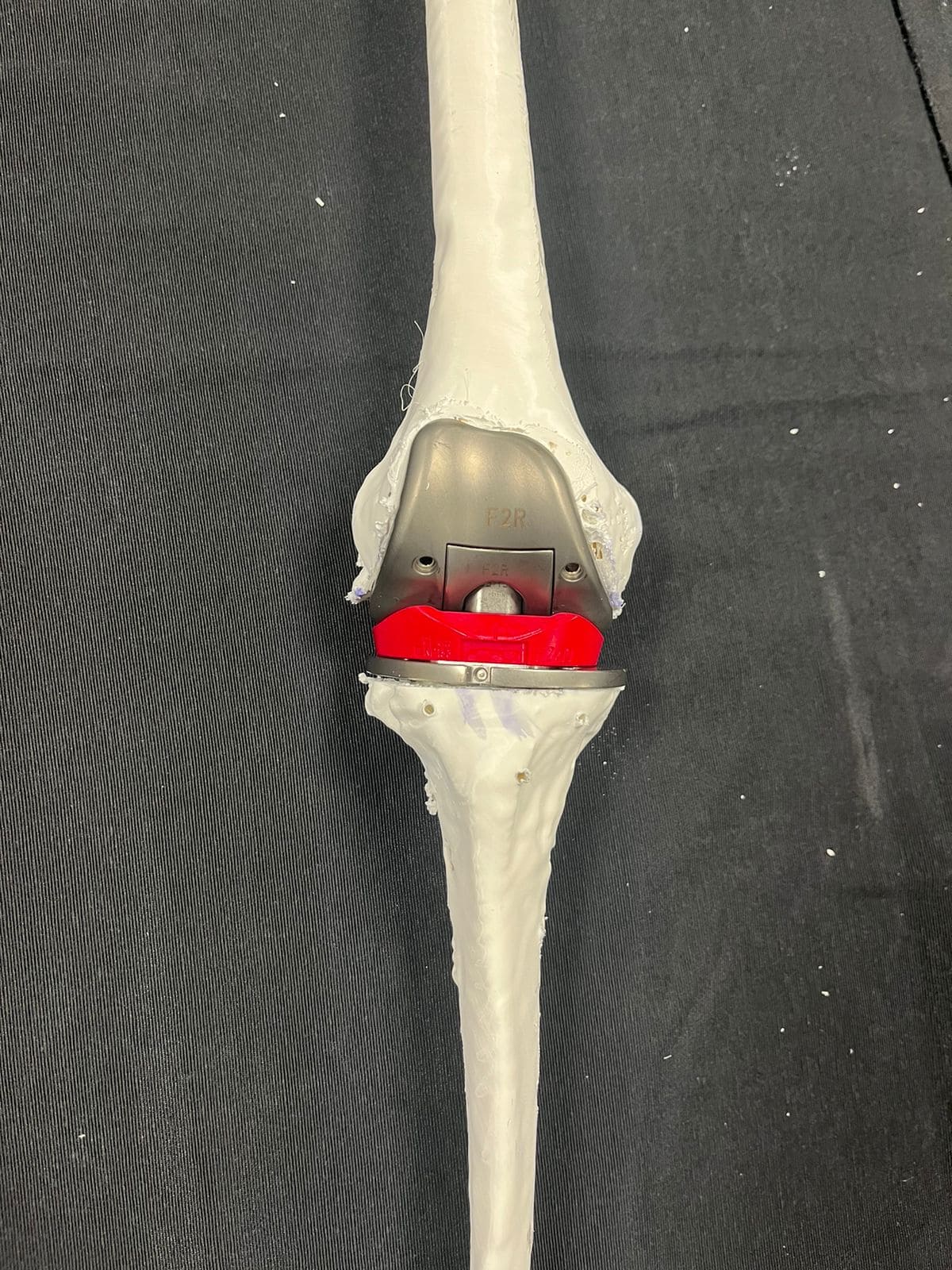O uso de próteses de dobradiça em cirurgias de atroplastia de joelho não é comum para pacientes com “ossos de vidro”. O Hospital Ortopédico AACD foi o primeiro a fazer esse procedimento, obtendo sucesso com o método inédito