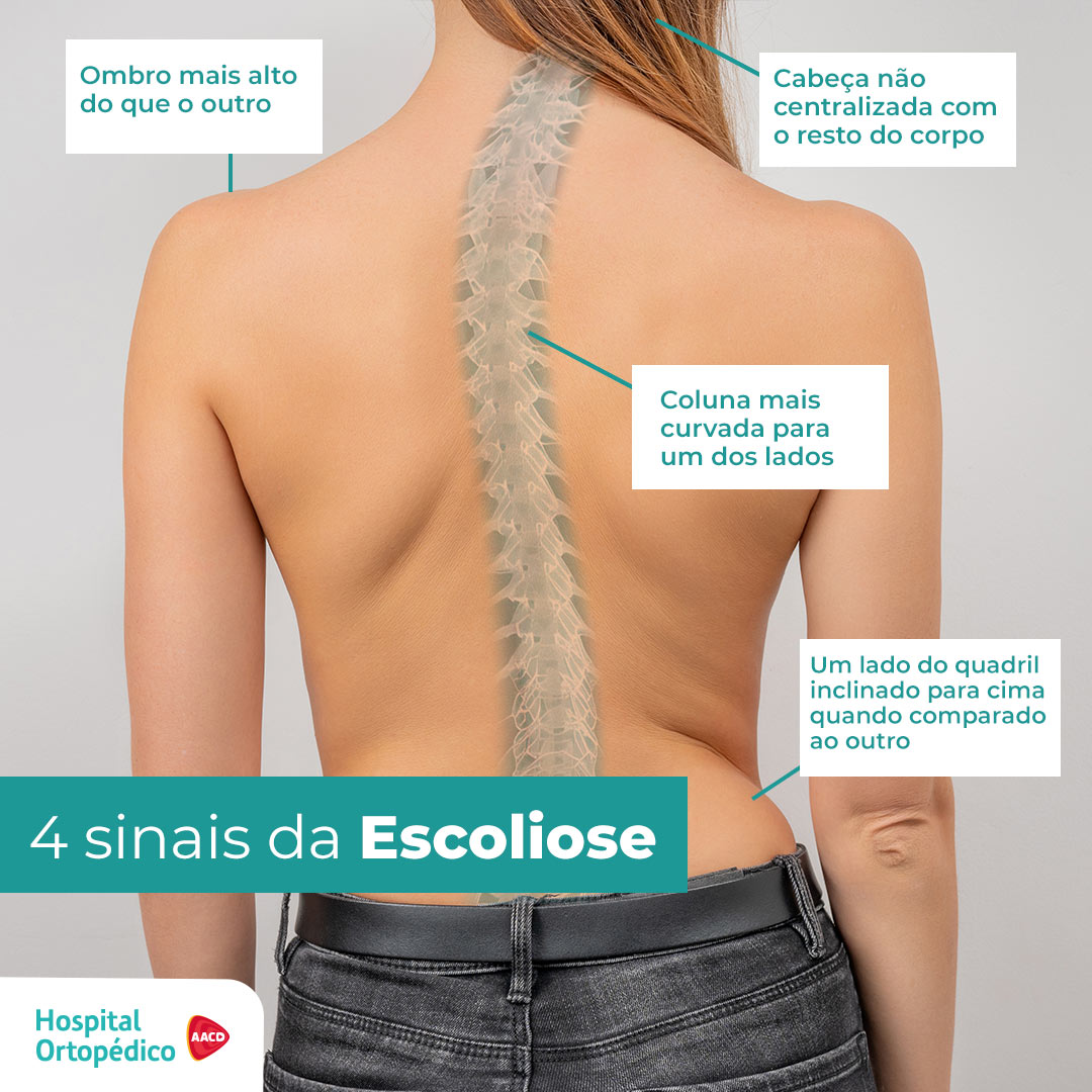 Tratamento para escoliose: entenda tudo sobre a patologia