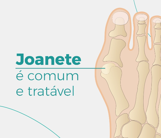 card que mostra uma ilustração dos ossos do pé com os dizeres "O joanete é comum e tratável".