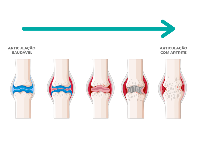 Ilustração das articulações prejudicadas por causa da artrite.