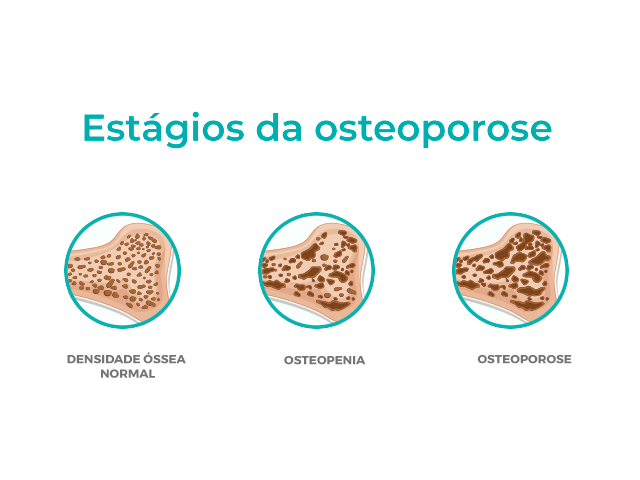 ilustração com desenhos de ossos que mostra os estágios da Osteoporose (densidade óssea normal, osteopenia e osteoporose).