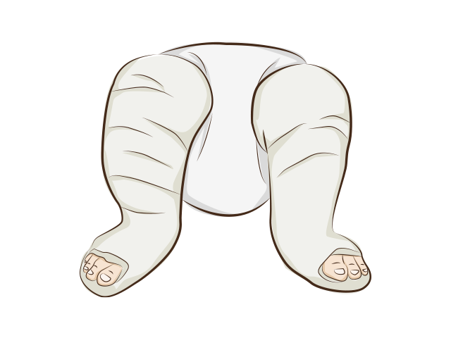 Ilustração das pernas e pés de um bebê imobilizado com gesso.