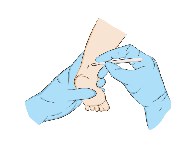 ilustração de cirurgia no calcanhar do bebê que corrige o pé torto congênito