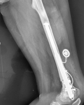 O Hospital Ortopédico AACD realizou a primeira cirurgia do Brasil para alongamento ósseo do fêmur com uma haste interna, comandada pelo ortopedista pediátrico Dr. Rafael Yoshida