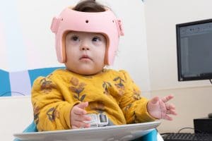 Criança usando órtese craniana produzida para tratamento individualizado.
