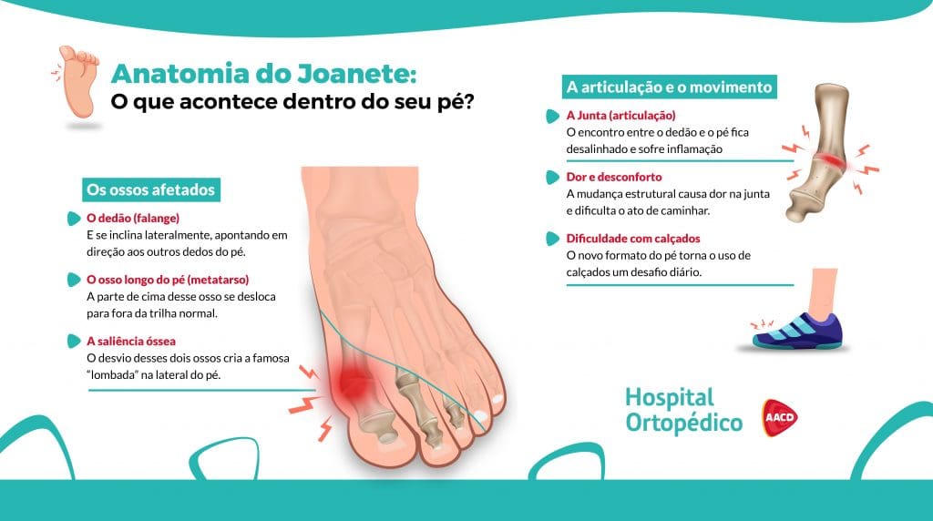 Ilustração da anatomia do joanete, mostrando o desvio do dedão, o osso metatarso deslocado e a saliência óssea, com destaque para a inflamação na articulação e os sintomas de dor e dificuldade com calçados.