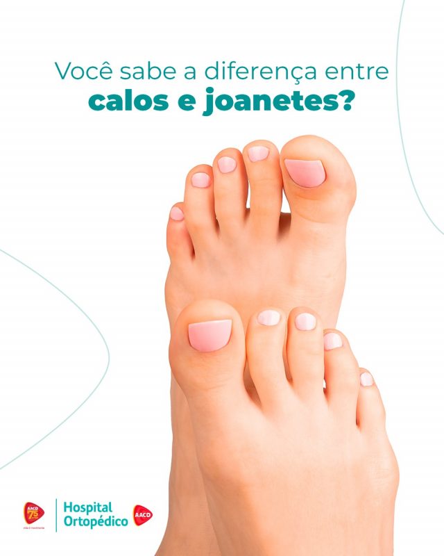 Você sabe diferenciar um calo de uma joanete? Podem até parecer iguais, mas não são! 🤔

↪️ O calo é uma área endurecida da pele, geralmente causada pela pressão ou atrito repetido. Já o joanete é uma deformidade óssea na articulação do dedão do pé, formando uma saliência.

👠 Apesar das diferenças, podem ter uma causa em comum: o uso de sapatos apertados ou inadequados, que contribuem para o desenvolvimento dessas condições.

❓ Tem alguma dúvida sobre o tema? Deixe sua pergunta nos comentários!

📲 No Hospital Ortopédico AACD você encontra especialistas em Pé e Tornozelo. Para agendar sua consulta, é fácil. Envie uma mensagem para o WhatsApp (11) 5576-0777. Atendemos particular e mais de 40 convênios.

RT: Dra. Renata Menegazzi dos Santos (CRM/SP: 113163)