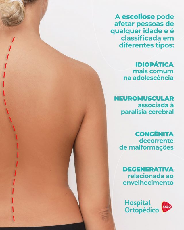 🌎 A escoliose é uma deformidade na coluna que afeta crianças, adultos e idosos no mundo todo. ​

❗️A faixa etária do acometimento é, inclusive, um dos fatores que determina o tipo de tratamento, dependendo do caso.​

↪️ A escoliose provoca alterações na coluna e pode apresentar diferentes causas e classificações.​
​
🏥 O Hospital Ortopédico AACD possui um Centro de Referência em Escoliose e oferece tratamento completo para a patologia. Conte com a nossa equipe para acompanhar você!​

✅ Atendemos particular e convênios. ​
​
📲 Consulta com hora marcada. Agende pelo WhatsApp (11) 5576-0777 ​
​
📍 Avenida Professor Ascendino Reis, 724 – Ibirapuera, São Paulo – SP ​
​
RT: Dra. Renata Menegazzi dos Santos (CRM/SP: 113163) ​