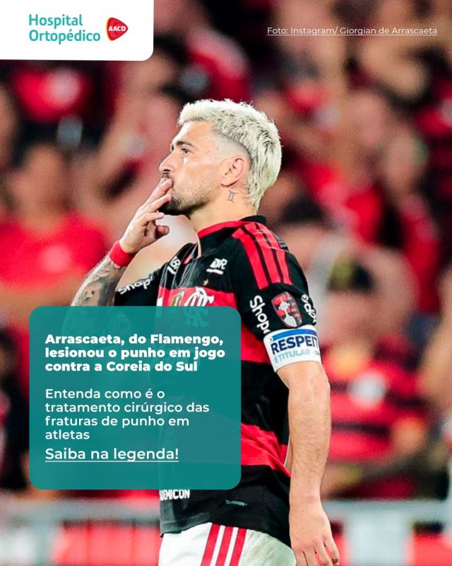 A fratura no punho esquerdo de Arrascaeta pegou os torcedores do Flamengo de surpresa e gerou dúvidas sobre o tratamento cirúrgico.​ 😳

👨‍⚕ O Dr. Ricardo Soares, nosso médico ortopedista, explicou como acontece o tratamento cirúrgico em situações como a de Arrascaeta:​

💬 Em atletas, a fixação interna (tratamento cirúrgico) das fraturas de punho pode permitir mobilização mais precoce e facilitar uma recuperação funcional mais rápida. ​

💬 "Não significa que a fratura estará consolidada antes com a cirurgia. A estabilidade proporcionada pelo implante (fixação da fratura) é diferente da consolidação biológica da fratura. O tempo de consolidação, em média, ocorre entre 6 e 8 semanas. Dessa maneira, tendemos a escolher o tratamento cirúrgico nas fraturas de punho em atletas."​

⤵ Ficou com alguma dúvida sobre esse caso? Escreva nos comentários!​

RT: Dra. Renata Menegazzi dos Santos (CRM/SP: 113163)​
